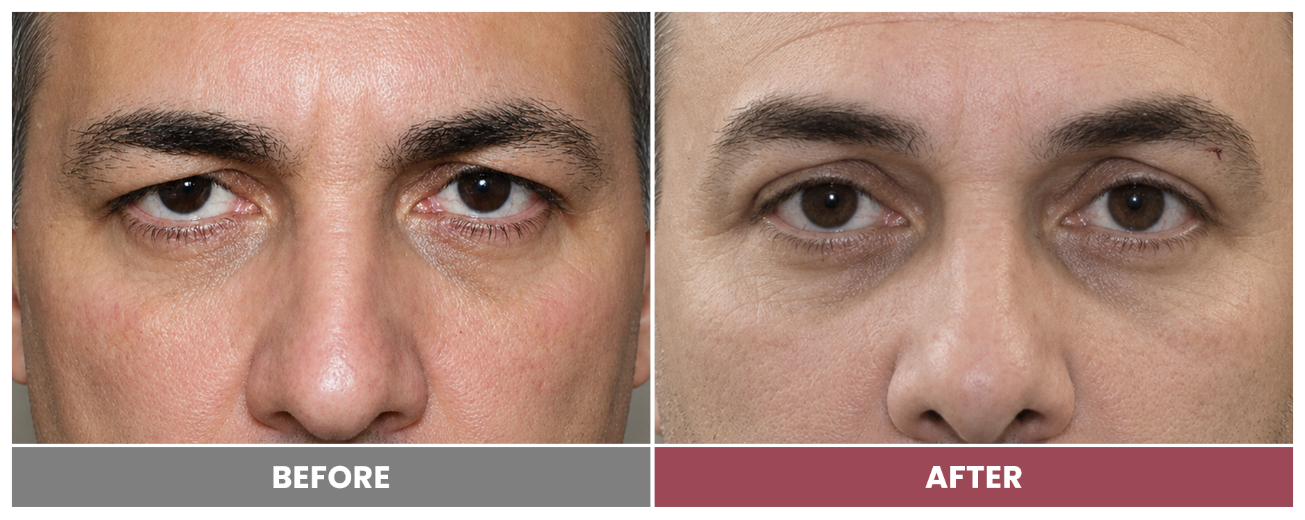 Upper Blepharoplasty - Case 50